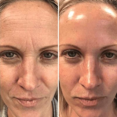 Velisse® Retinal Shot - Adiós Arrugas