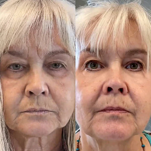 Parches Mágicos (30 Días) | Desaparece Ojeras y Bolsas en los Ojos
